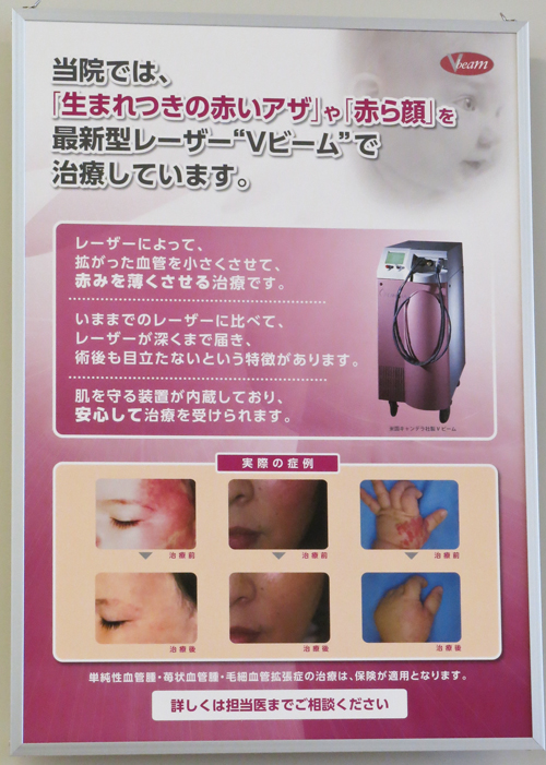Ricoママのシミがとれた〜!荘内病院形成外科レーザー治療!